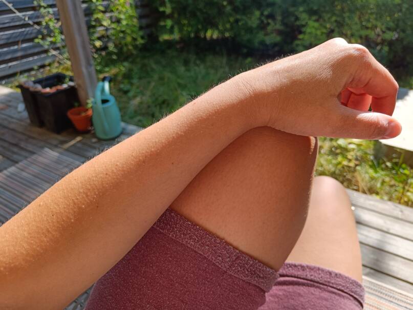 Piolveen nojaava kyynärvarsi, jossa ihokarvat ovat nousseet pystyyn ns. kananlihalle.